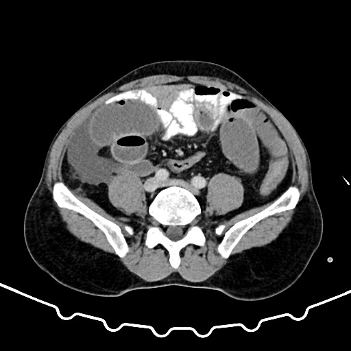 File:Colocolic intussusception due to large lipoma (Radiopaedia 68773-78482 A 128).jpg