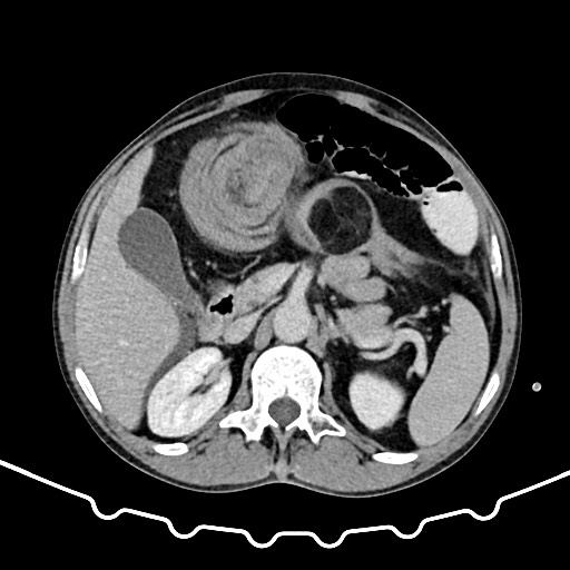 Colocolic intussusception due to large lipoma (Radiopaedia 68773-78482 A 56).jpg
