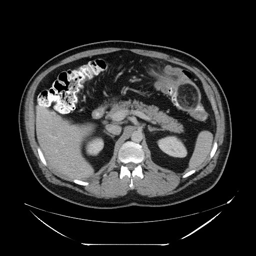 Colocolic intussusception due to lipoma (Radiopaedia 73712-84508 A 37).jpg