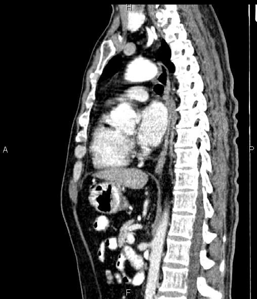 Colon adenocarcinoma (Radiopaedia 83266-97671 D 61).jpg
