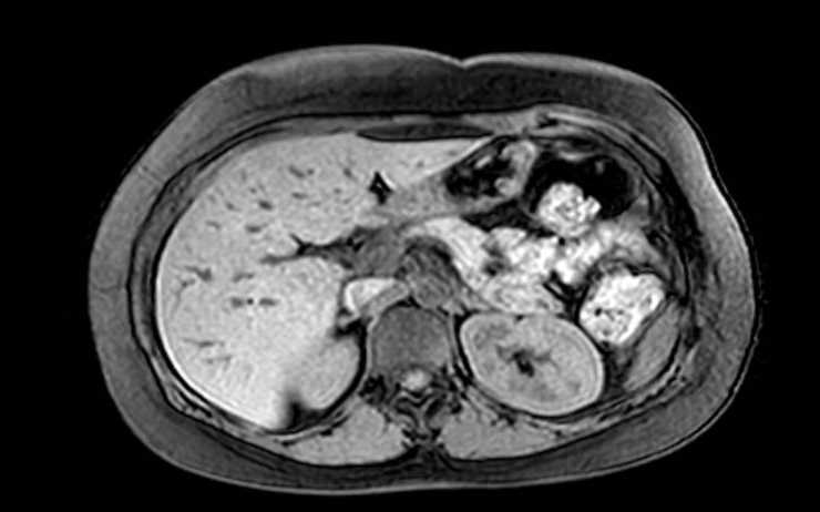 Colon adenocarcinoma with Krukenberg tumors, advanced pregnancy (Radiopaedia 67279-76645 A 60).jpg