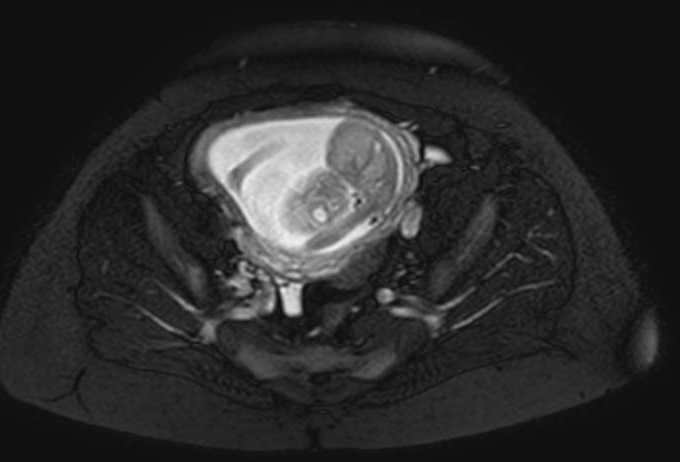 Colon adenocarcinoma with Krukenberg tumors, advanced pregnancy (Radiopaedia 67279-76645 Axial T2 SPAIR 17).jpg