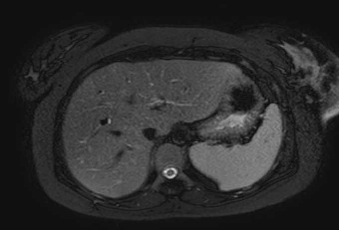 File:Colon adenocarcinoma with Krukenberg tumors, advanced pregnancy (Radiopaedia 67279-76645 Axial T2 SPAIR 70).jpg