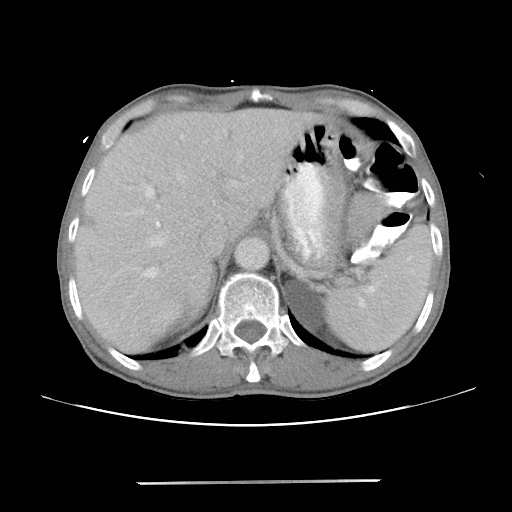 Colon cancer with calcified liver metastasis (Radiopaedia 74423-85307 A 17).jpg