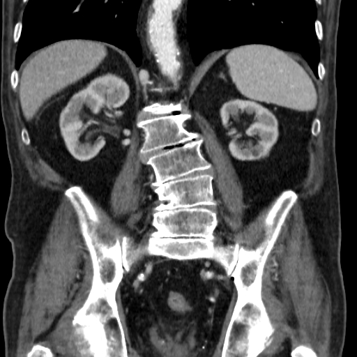 File:Colon cancer with duodenal invasion (Radiopaedia 16278-15958 B 41).jpg