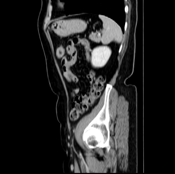 Colon carcinoma with hepatic metastases (Radiopaedia 29477-29961 C 44).jpg