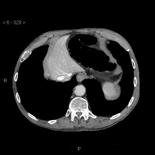 Colonic cancer (ultrasound and TC imaging) (Radiopaedia 50346-55713 B 328).jpg