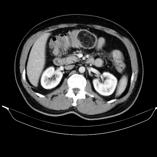Colonic lipoma with colo-colic intussusception (Radiopaedia 58944-66200 A 24).jpg