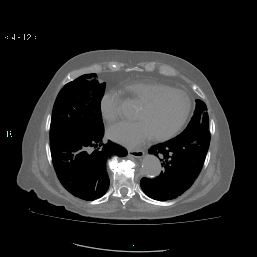 Colonic lipomas (Radiopaedia 49137-54244 Axial bone window 6).jpg