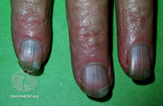 File:Discolouration induced by minocycline (DermNet NZ drug-induced-nail-5).jpg