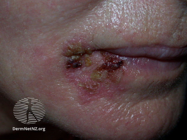 Intraepidermal carcinoma (DermNet NZ lesions-scc-in-situ-2941).jpg