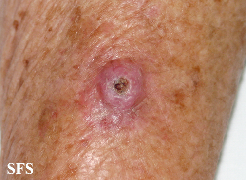 File:Keratoacanthoma (Dermatology Atlas 54).jpg