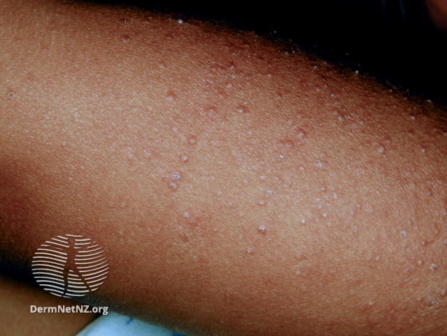 File:Keratosis pilaris in dark skin (DermNet NZ acne-keratosis-pilaris-1).jpg