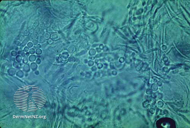 File:Malassezia microscopy (DermNet NZ fungal-pitver3).jpg