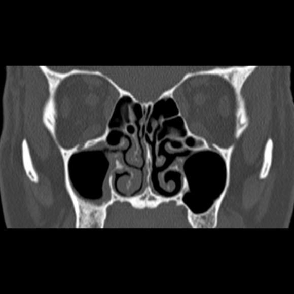 Nasal septal perforation (Radiopaedia 25030-25289 Coronal bone window 36).jpg