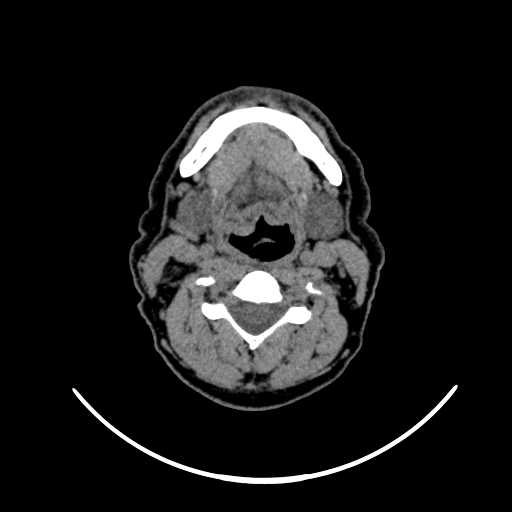 File:Nasopharyngeal carcinoma - infiltrating the clivus (Radiopaedia 62583-70875 Axial non-contrast 40).jpg