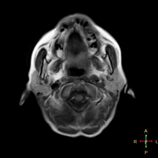 File:Nasopharyngeal carcinoma infiltrating the clivus (Radiopaedia 25229-25481 Axial T1 1).jpg