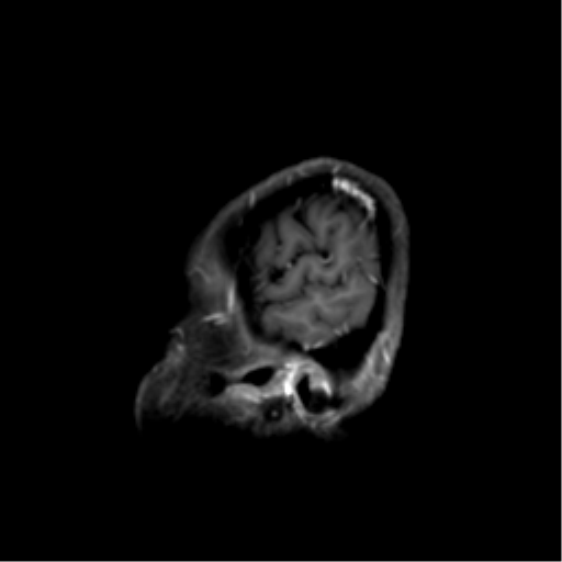 Nasopharyngeal carcinoma with cerebral abscess (Radiopaedia 43018-46274 J 49).png