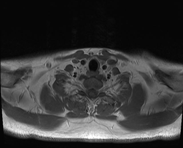 File:Nasopharyngeal carcinoma with perineural spread (Radiopaedia 55030-61380 Axial T1 3).jpg