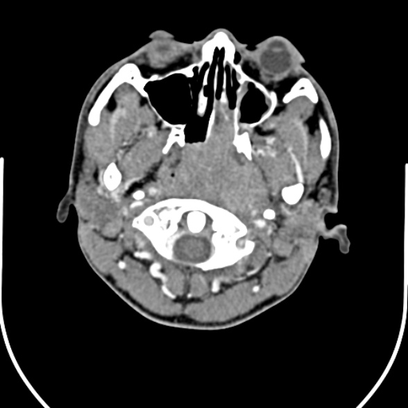File:Nasopharyngeal carcinoma with skull base invasion (Radiopaedia 53415-59705 A 42).jpg