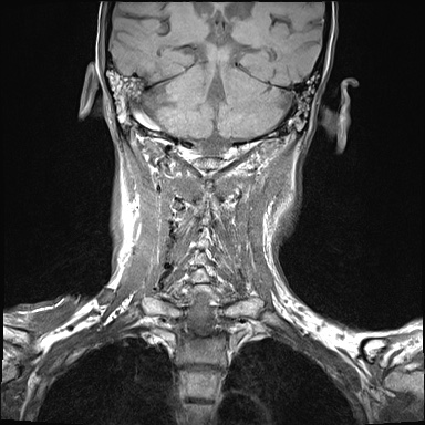File:Nasopharyngeal carcinoma with skull base invasion (Radiopaedia 59258-66600 Coronal T1 5).jpg