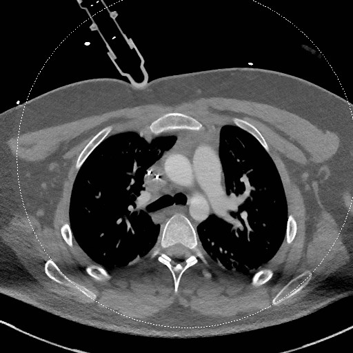 Neck CT angiogram (intraosseous vascular access) (Radiopaedia 55481-61945 B 43).jpg