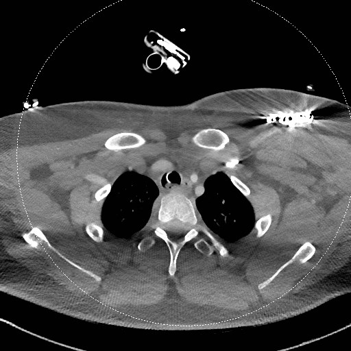 Neck CT angiogram (intraosseous vascular access) (Radiopaedia 55481-61945 B 87).jpg