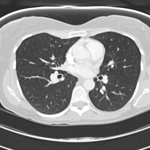 Necrobiotic pulmonary nodules - Crohn disease (Radiopaedia 20723-20631 Axial lung window 72).jpg