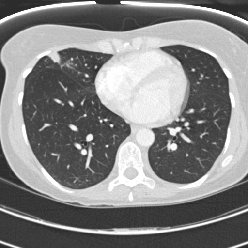 Necrobiotic pulmonary nodules - Crohn disease (Radiopaedia 20723-20631 Axial lung window 92).jpg