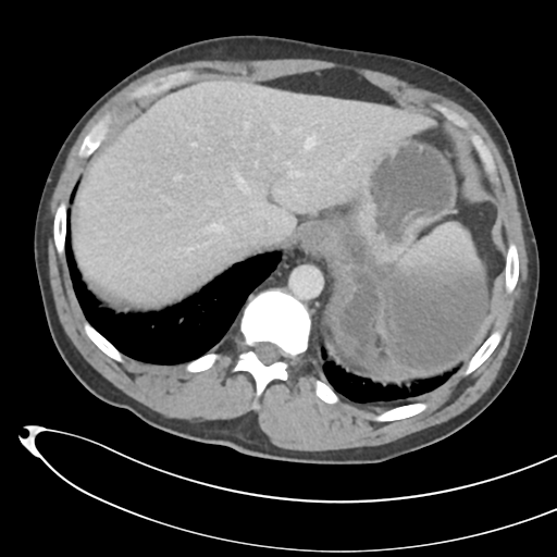 File:Necrotizing pancreatitis with acute necrotic collections (Radiopaedia 38829-41012 B 15).png