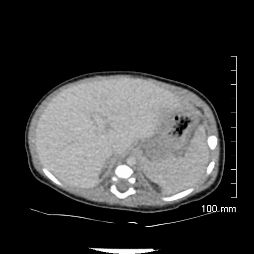 File:Neonatal neuroblastoma (Radiopaedia 56651-63438 Axial non-contrast 21).jpg