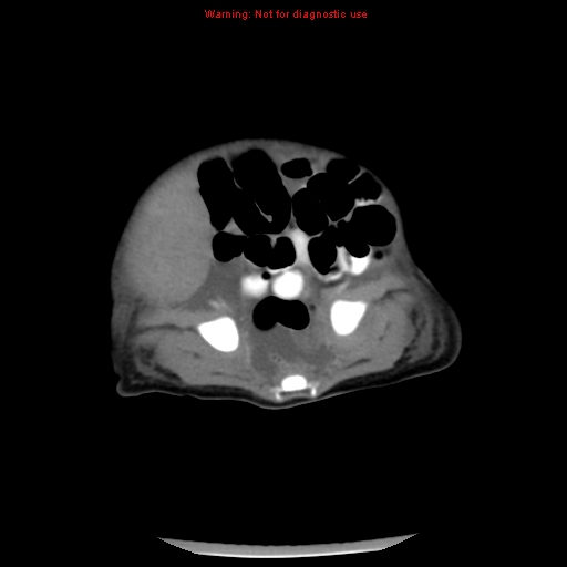 File:Neonatal neuroblastoma (Radiopaedia 9564-10223 A 41).jpg