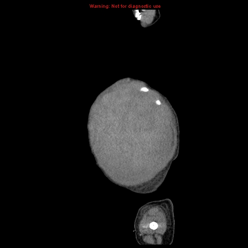 File:Neonatal neuroblastoma (Radiopaedia 9564-10223 C 13).jpg