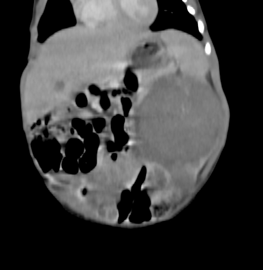 Nephroblastomatosis (Radiopaedia 71294-81607 B 123).jpg