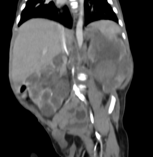 Nephroblastomatosis (Radiopaedia 71294-81607 B 208).jpg