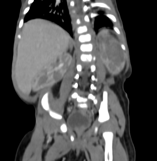 Nephroblastomatosis (Radiopaedia 71294-81607 B 243).jpg