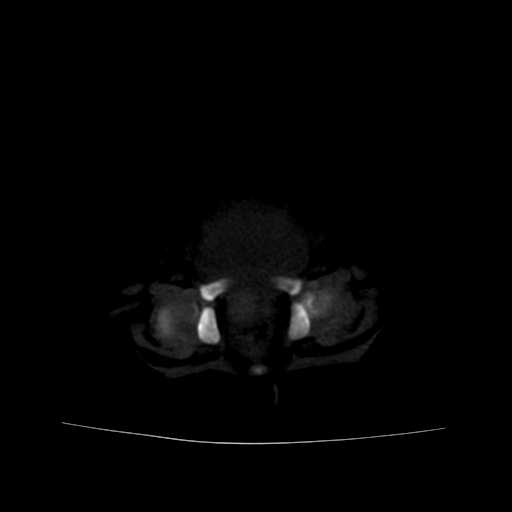 File:Neuroblastoma (Radiopaedia 20876-20799 Axial bone window 23).jpg