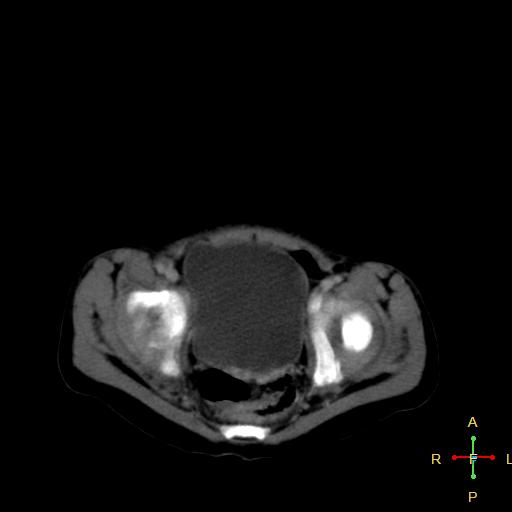 File:Neuroblastoma (Radiopaedia 24751-25016 D 40).jpg