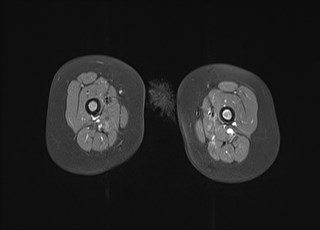 File:Neuroblastoma with bone metastases (Radiopaedia 67080-76414 Axial T1 C+ fat sat 28).jpg