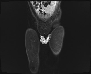 File:Neuroblastoma with bone metastases (Radiopaedia 67080-76414 Coronal STIR 2).jpg