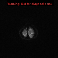File:Neurofibromatosis type 1 with optic nerve glioma (Radiopaedia 16288-15965 Axial DWI 25).jpg