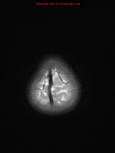 File:Neurofibromatosis type 1 with optic nerve glioma (Radiopaedia 16288-15965 Axial T2 2).jpg
