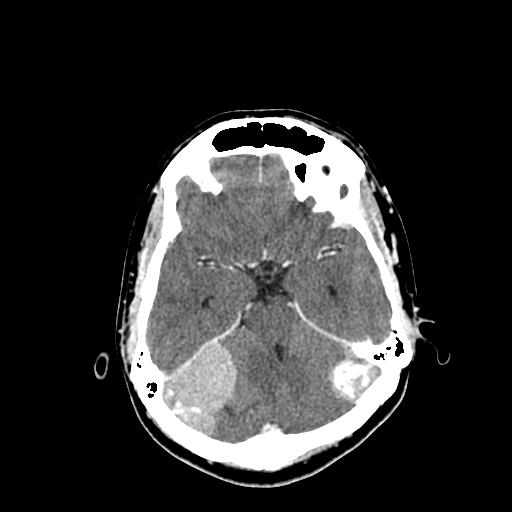 File:Neurofibromatosis type 2 (Radiopaedia 25389-25637 Axial C+ 26).jpg