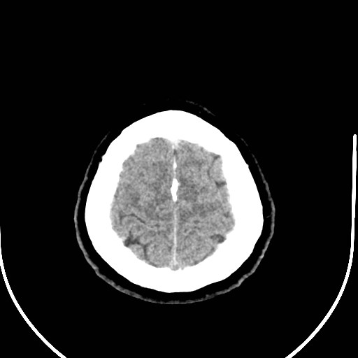 Neurofibromatosis type 2 (Radiopaedia 79097-92047 Axial non-contrast 55).jpg