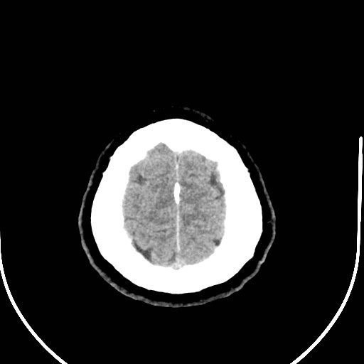 Neurofibromatosis type 2 (Radiopaedia 79097-92047 Axial non-contrast 56).jpg