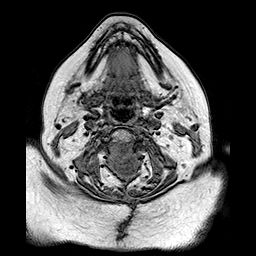 File:Neurofibromatosis type 2 (Radiopaedia 8713-9518 Axial T1 30).jpg