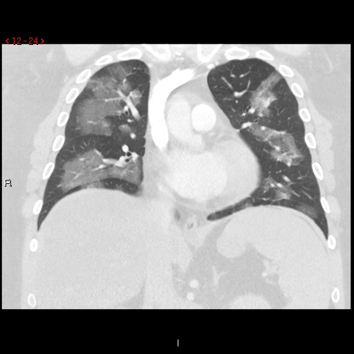 File:Non-specific interstitial pneumonitis (Radiopaedia 27044-27222 Coronal lung window 24).jpg