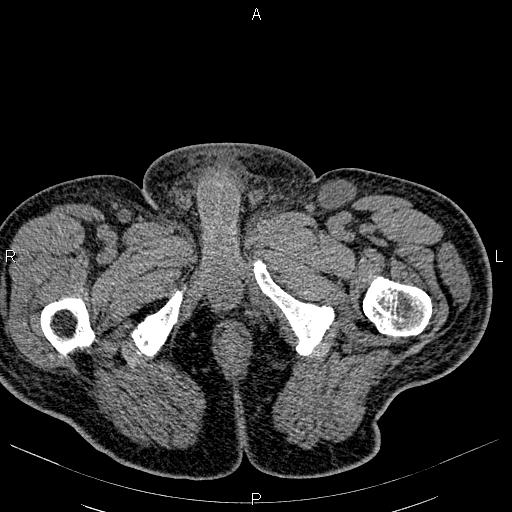 File:Non Hodgkin lymphoma in a patient with ankylosing spondylitis (Radiopaedia 84323-99621 Axial non-contrast 67).jpg