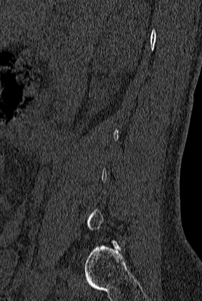 File:Normal CT lumbar spine (Radiopaedia 53981-60118 Sagittal bone window 9).jpg
