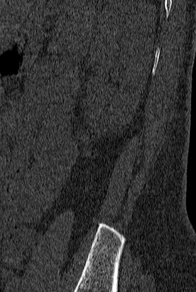 File:Normal CT lumbar spine (Radiopaedia 53981-60118 Sagittal bone window 98).jpg